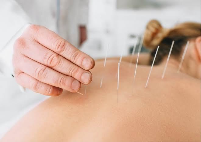 Dry Needling and cupping