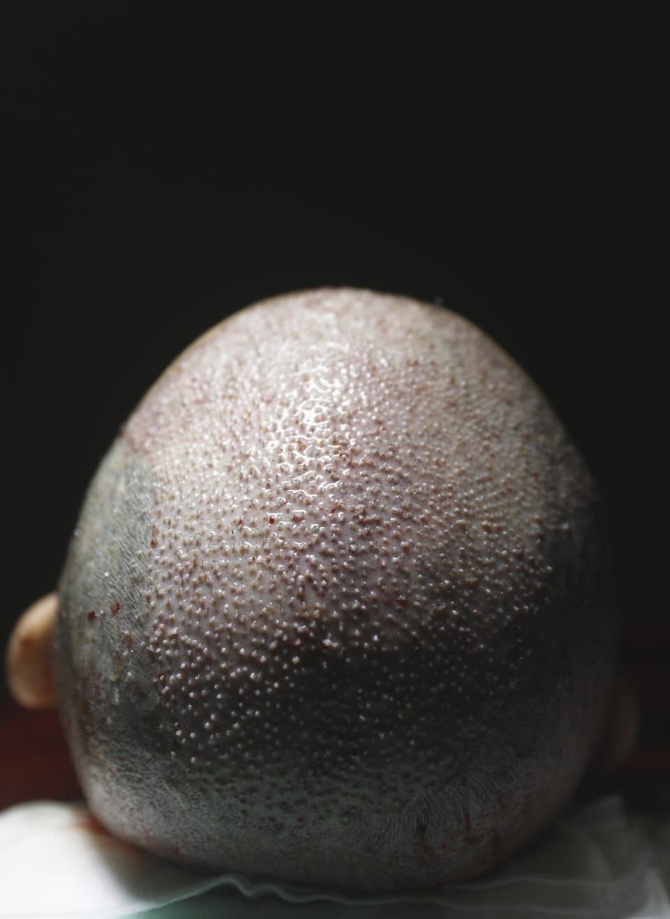Hair transplantation