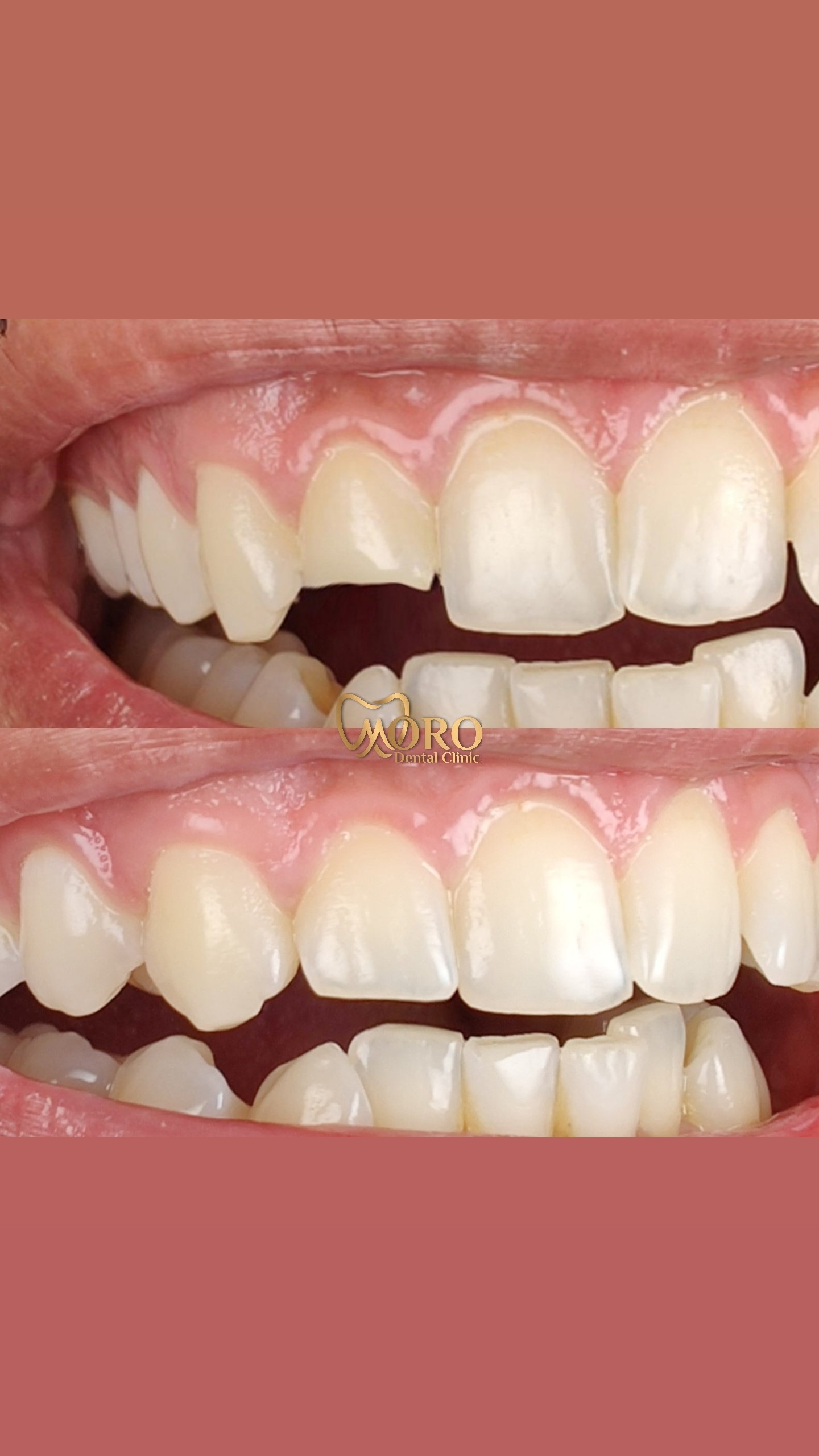 حشو ليزر تجميلى