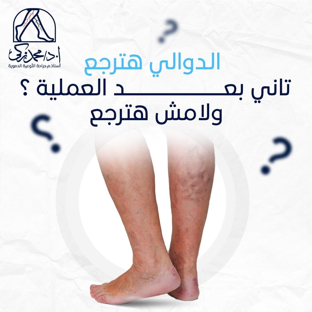 جلسات حقن دوالى الساق