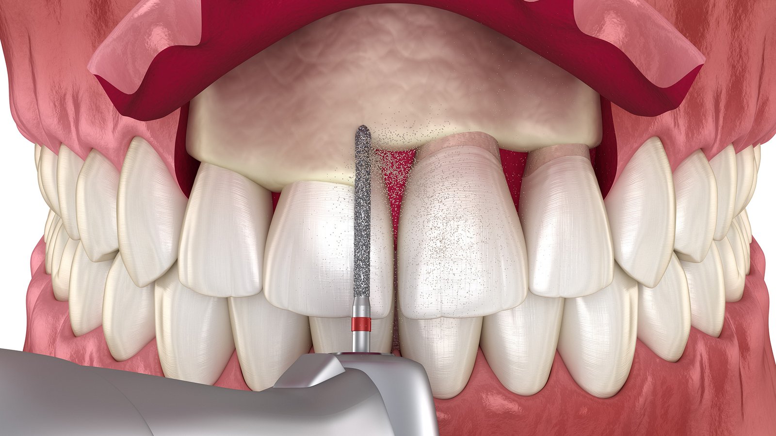 Crown lengthening