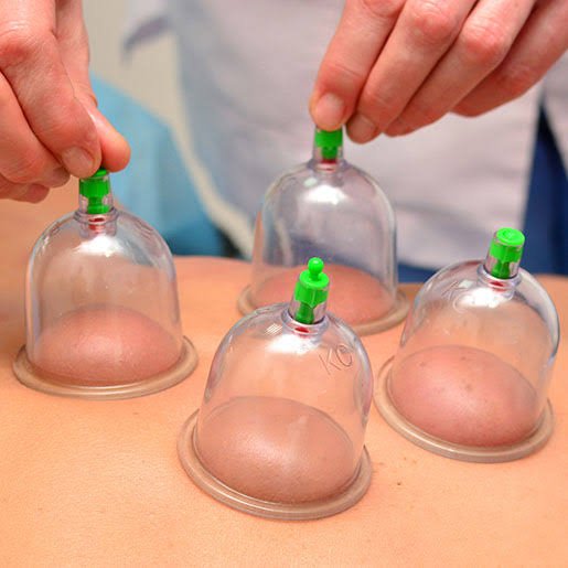 Cupping therapy