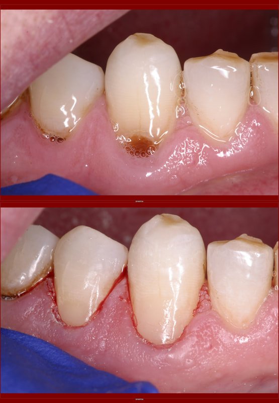 الحشوات التجميلية