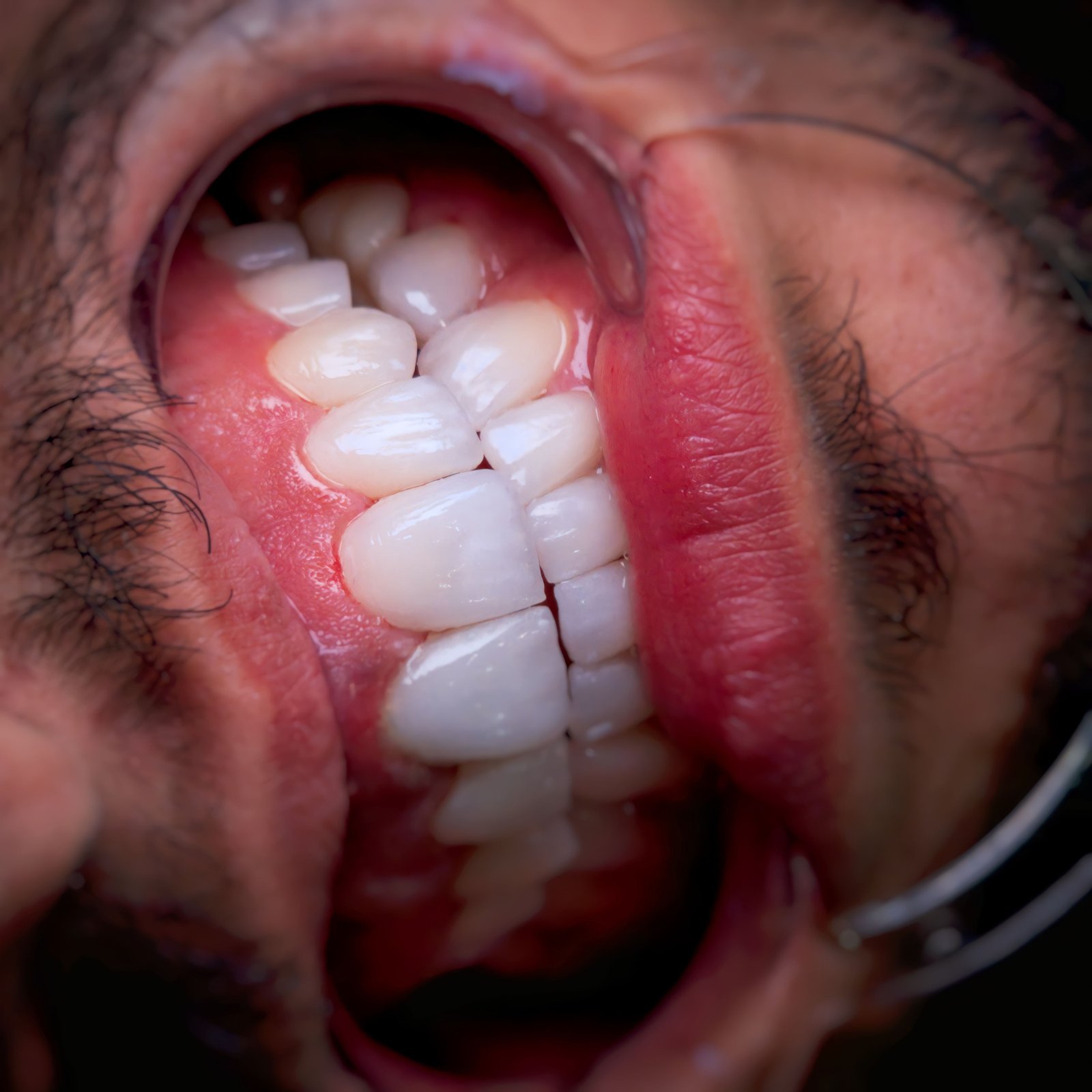 E-max Veneer
