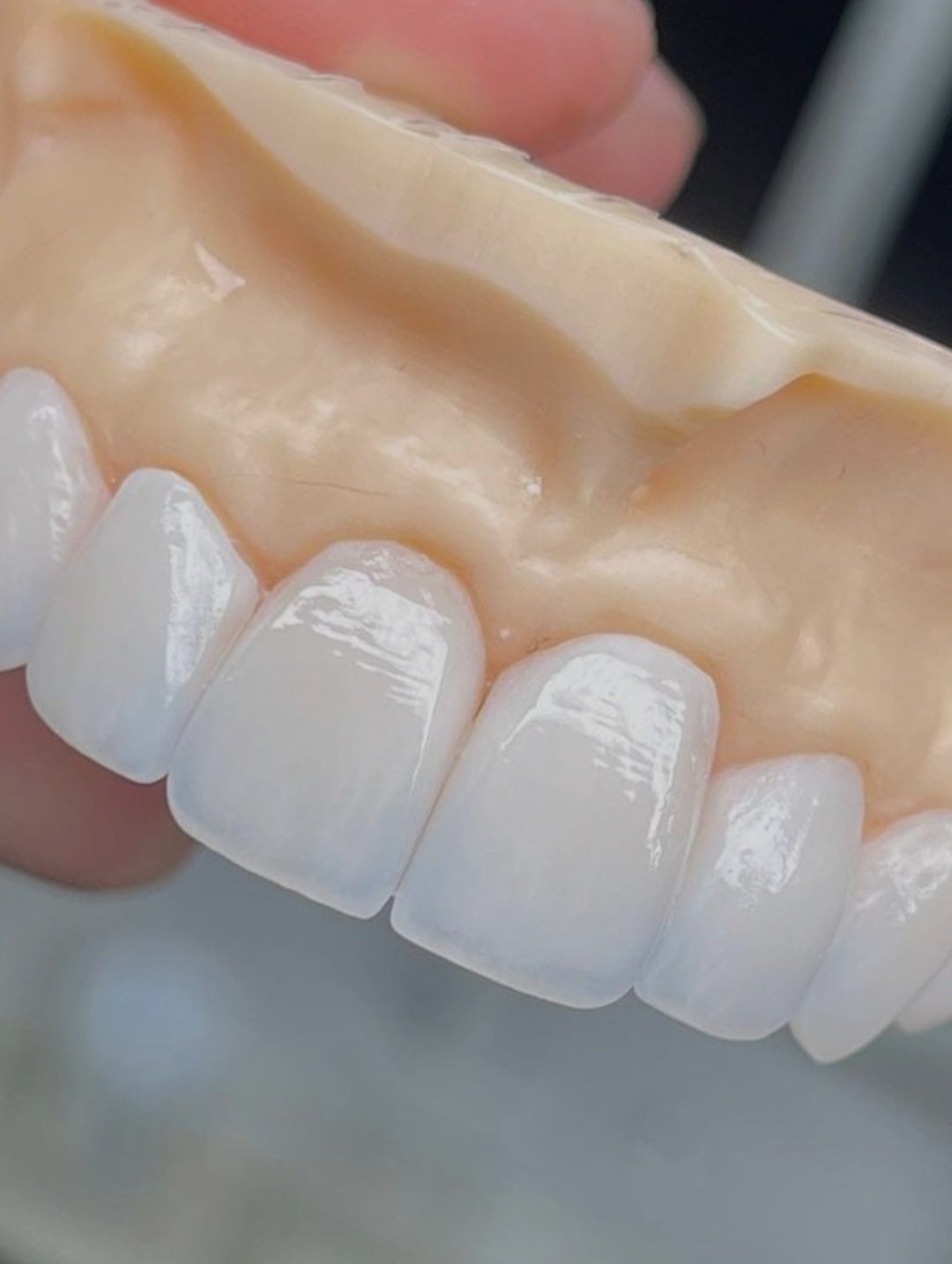 feldspathic veneers