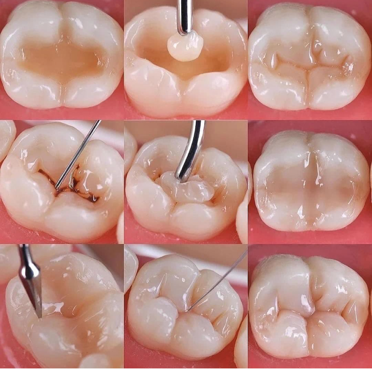 composite filling