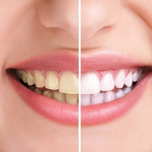 dental bleaching