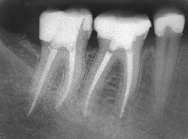 root canal treatment