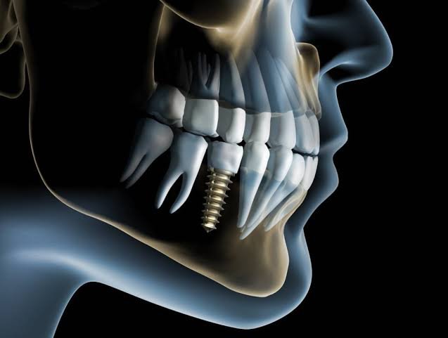 Implant (زراعة)