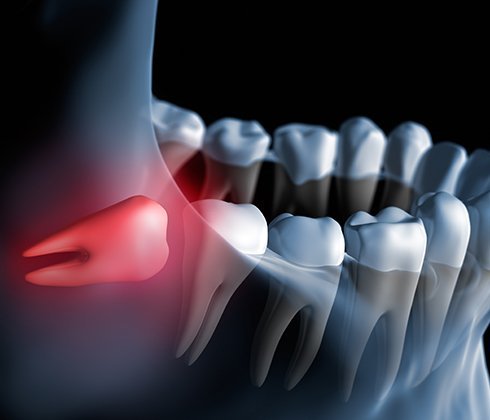 Impaction (إزلة جراحيه لضرس العقل)