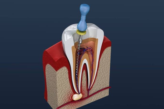 Endodontic Treatment (حشو العصب)