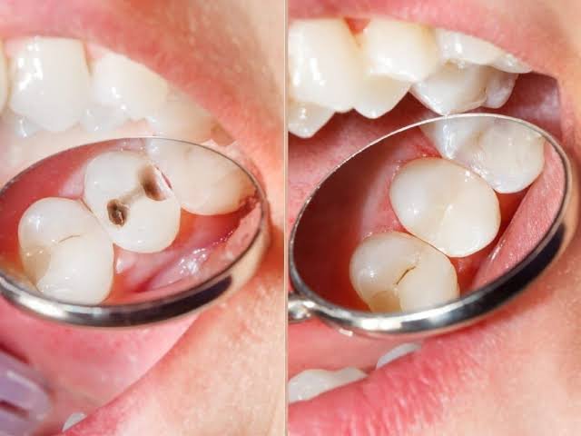 Composite Restoration (حشو ليزر تجميلي)