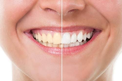 Laser whitening