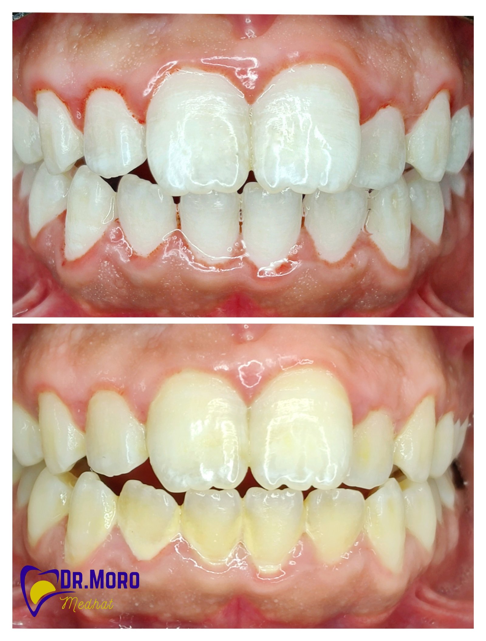 تبييض الاسنان بالليزر