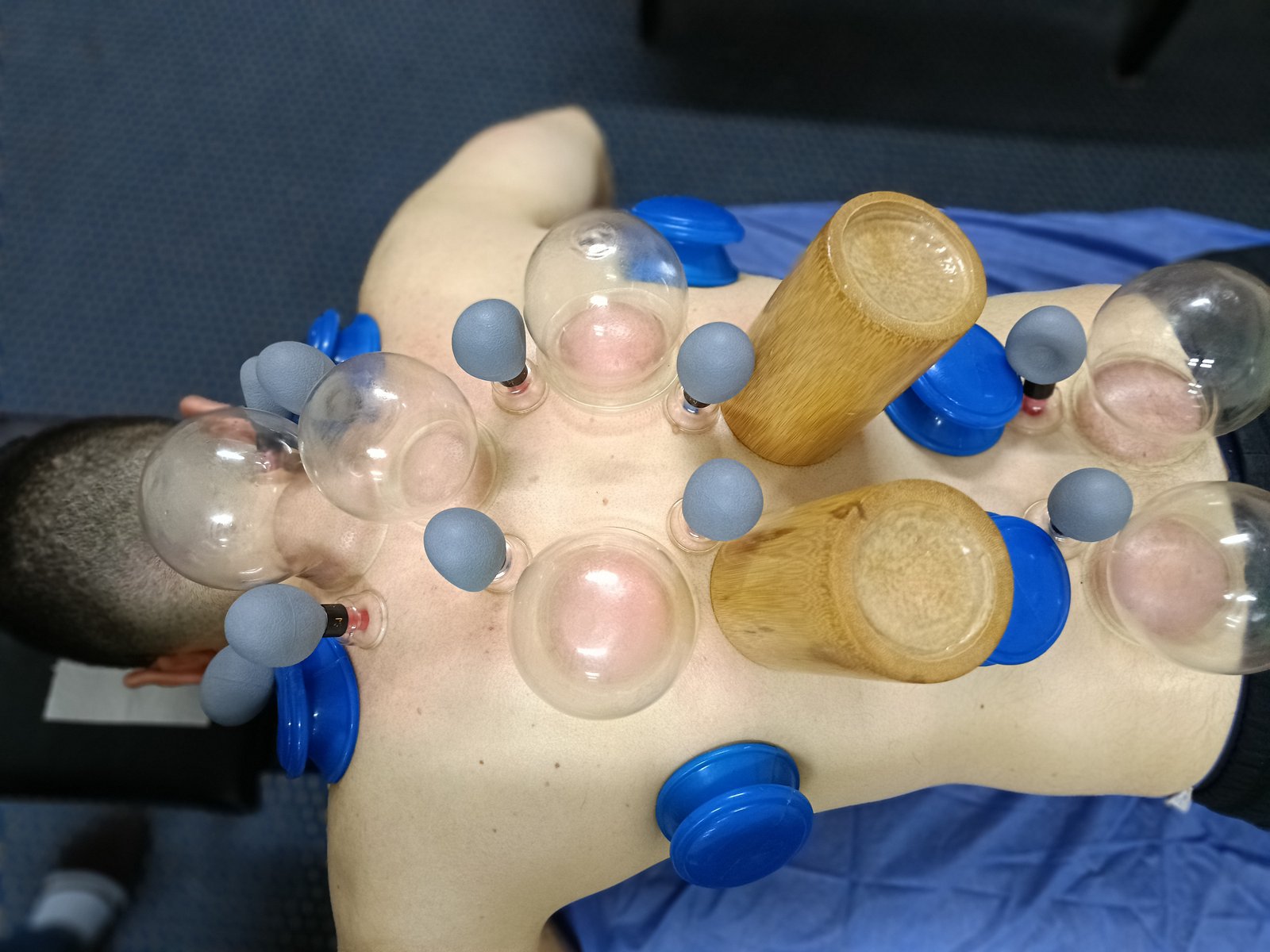 Dry cupping