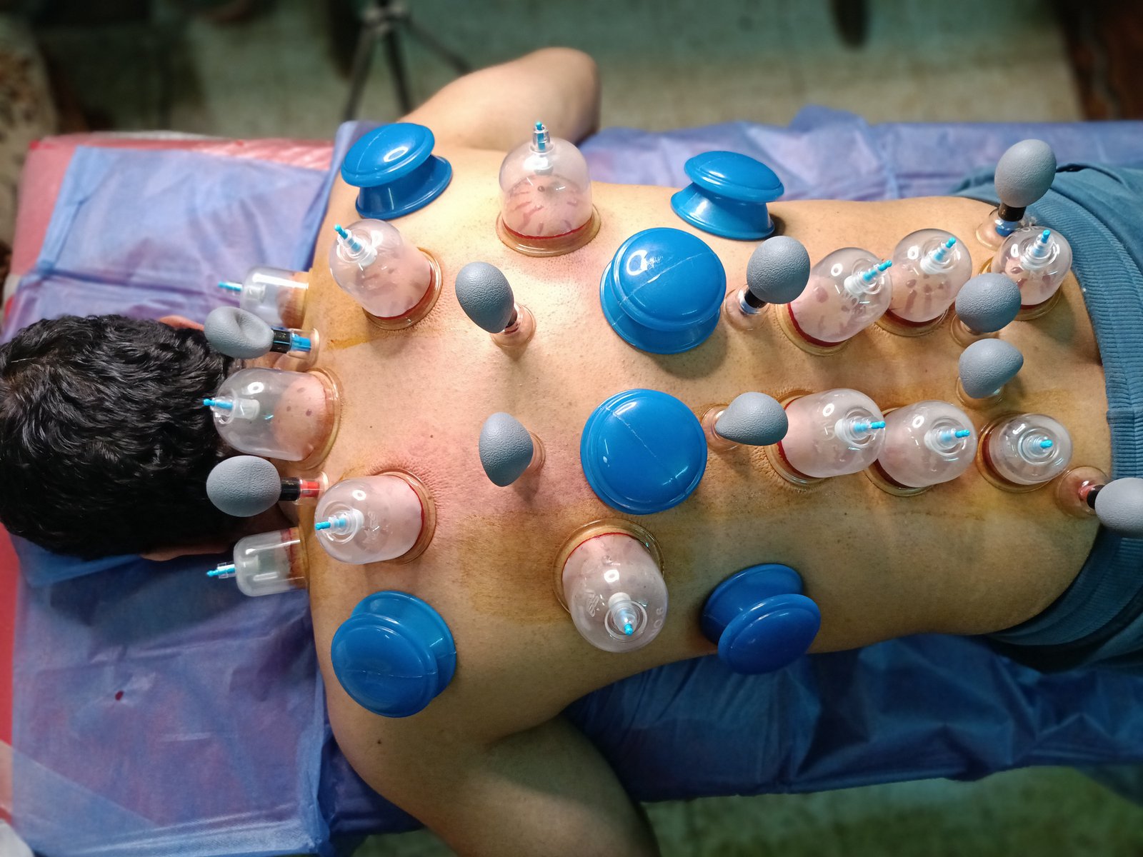 Cupping therapy