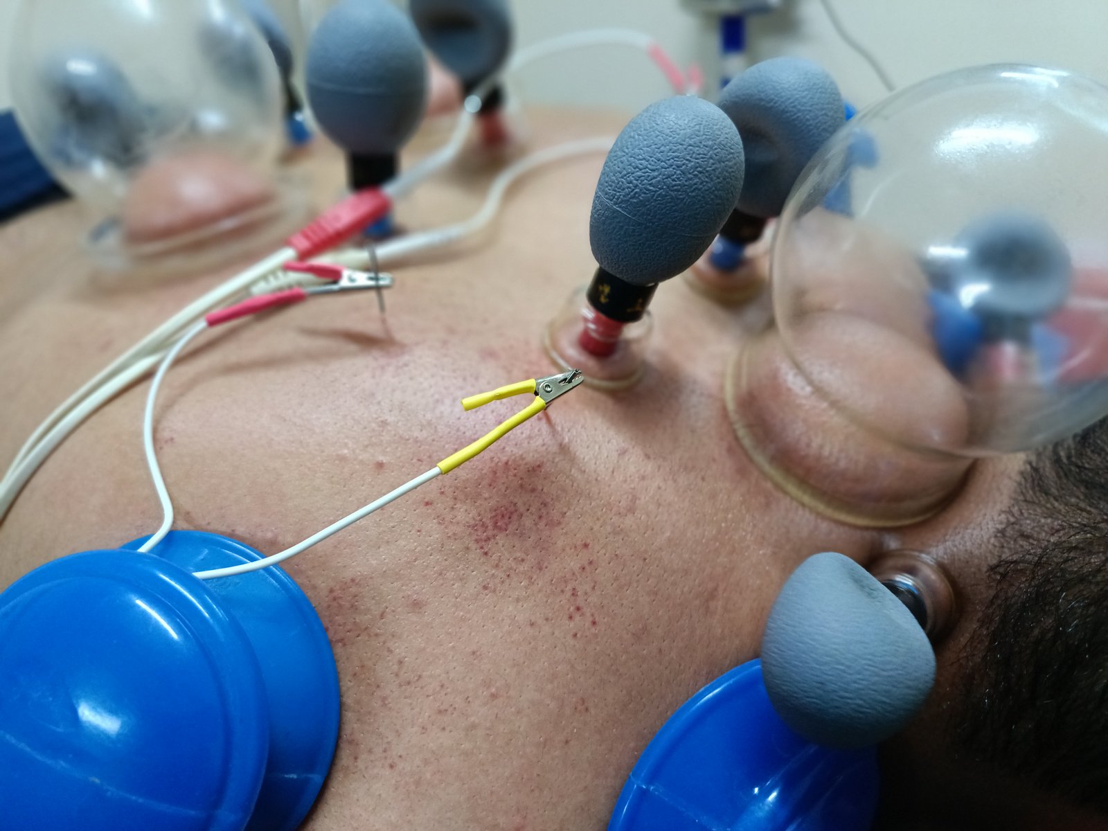 Dry needling