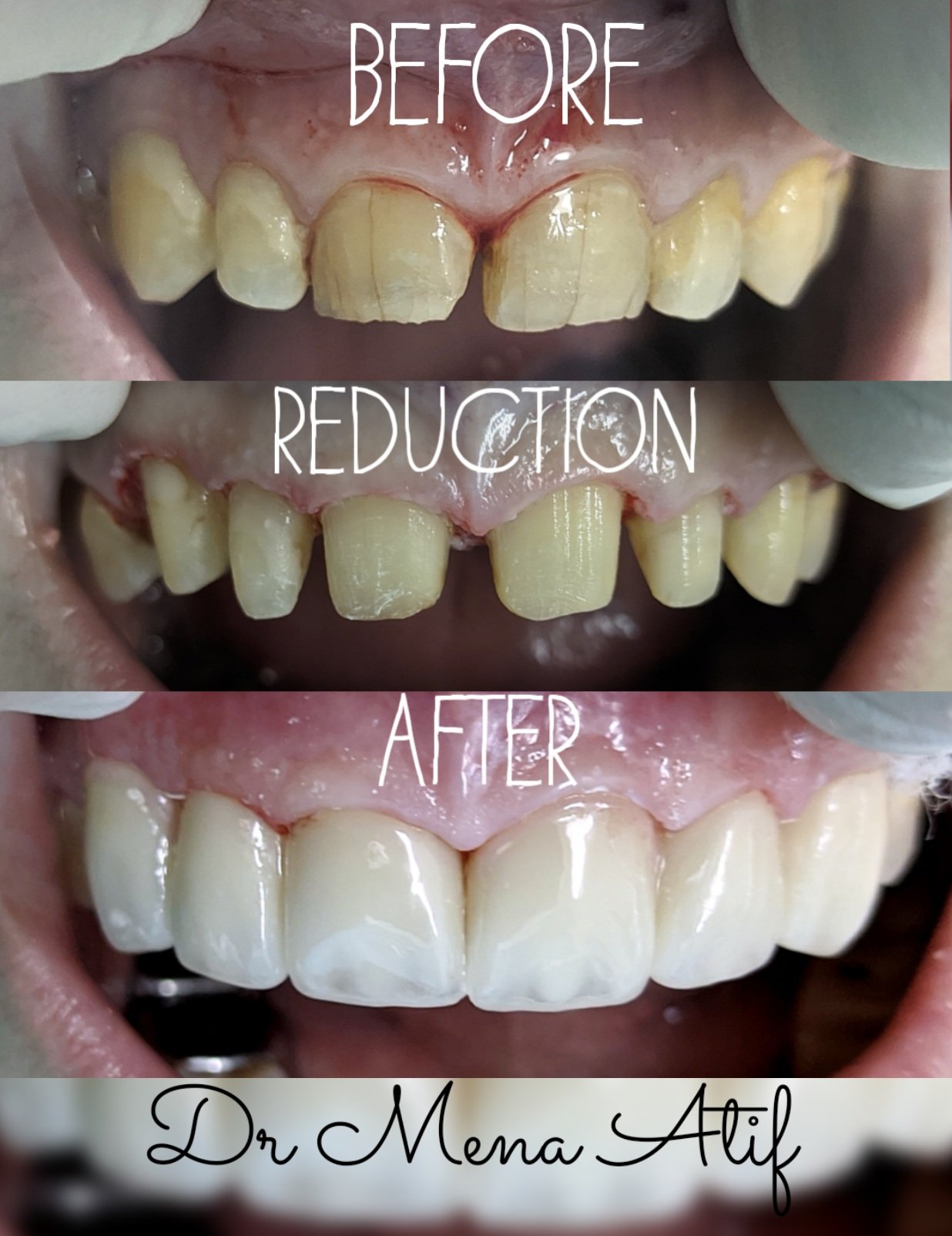 Hollywood smile Design