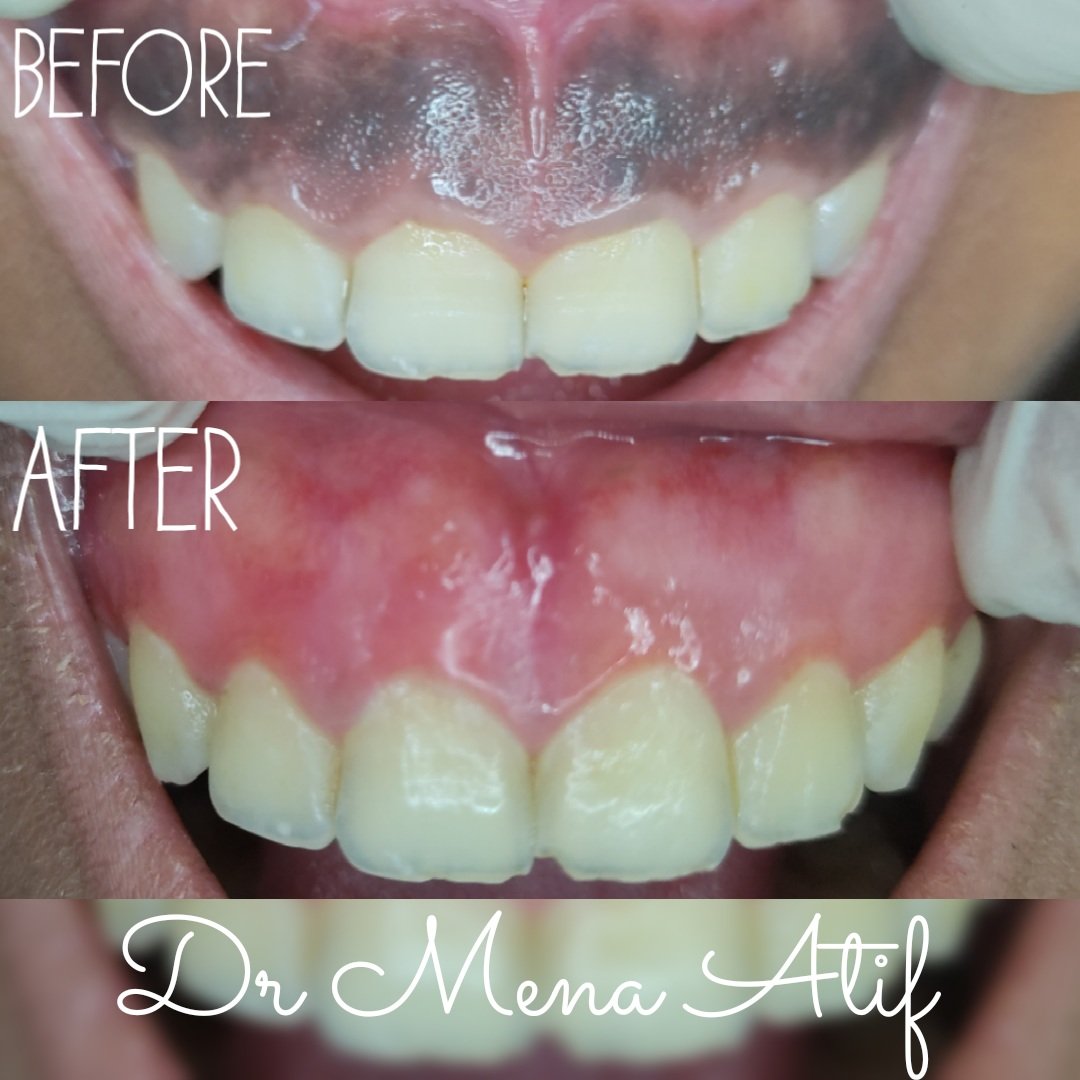 Gingival Depigmentation