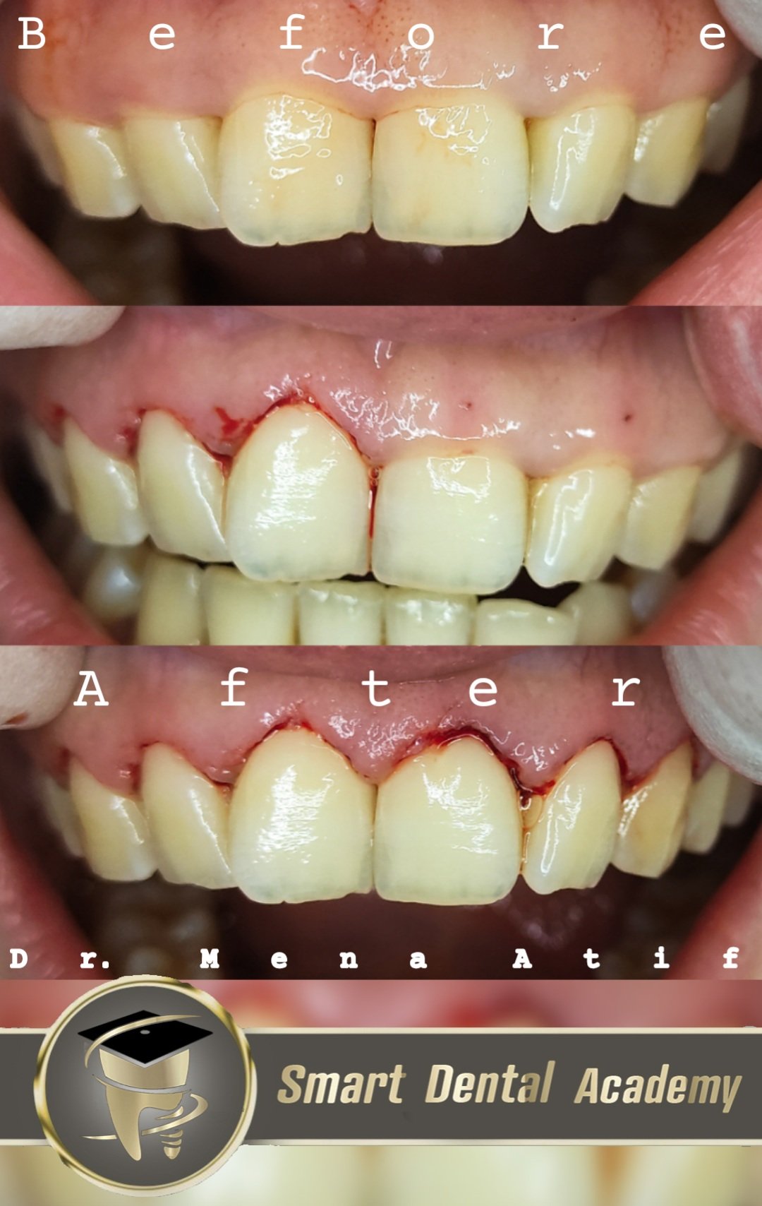 Esthetic Crown lengthening