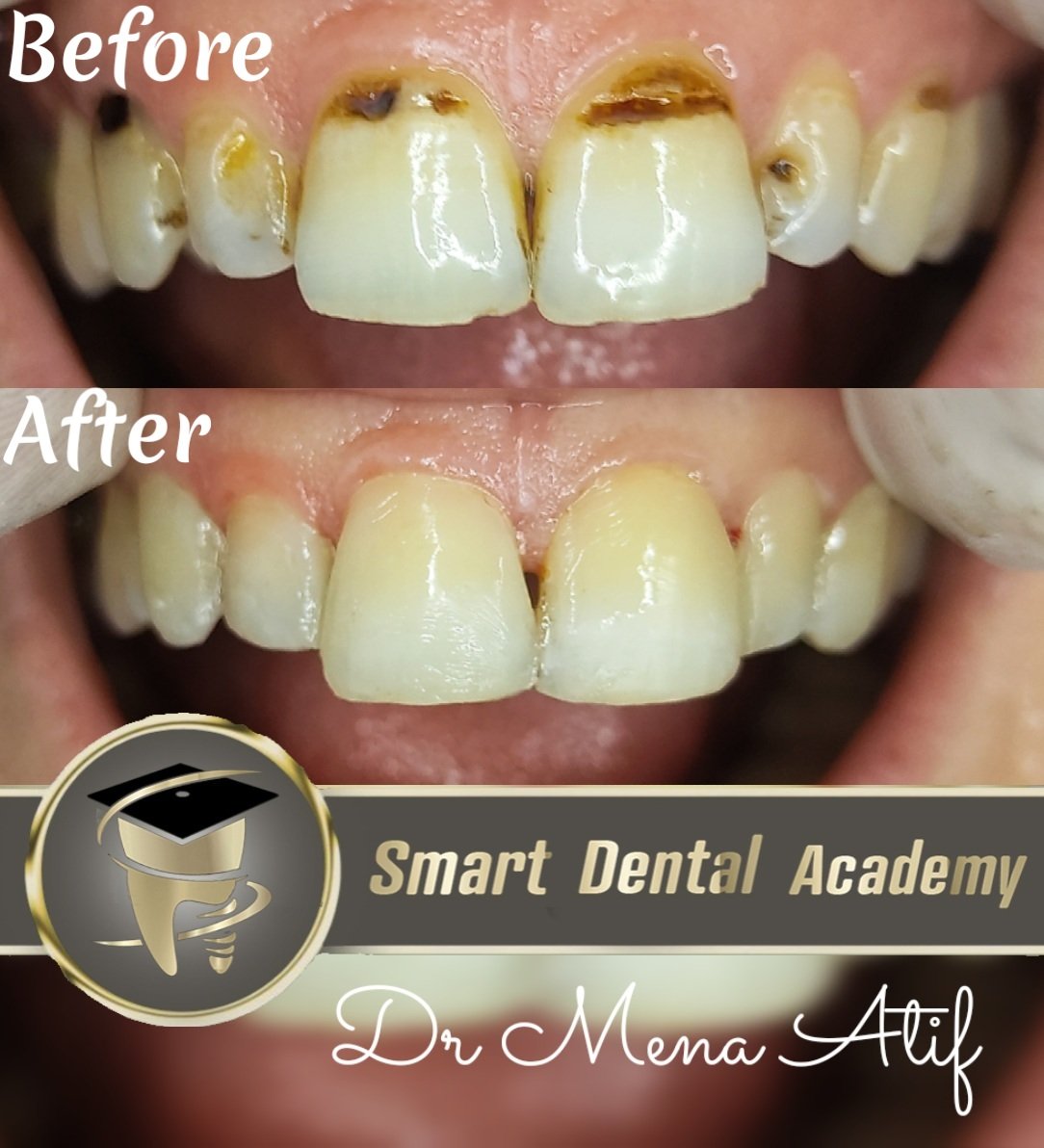 Esthetic teeth restoration